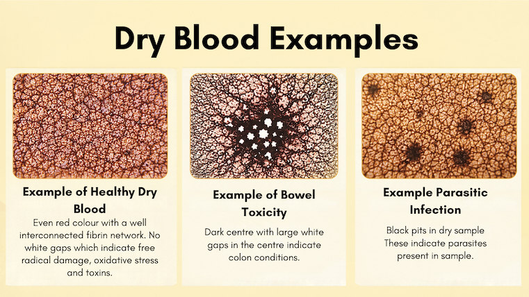 Sunshine Holistic Health Dry Blood Example